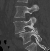 Spondylithesis Elongated